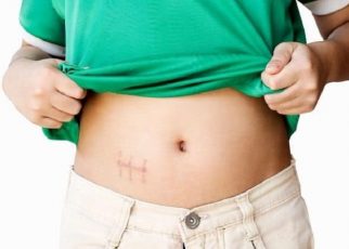 Est-il possible de perdre du poids après l’ablation de la vésicule biliaire