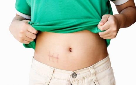 Est-il possible de perdre du poids après l’ablation de la vésicule biliaire